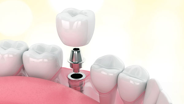 single dental implant with ceramic crown