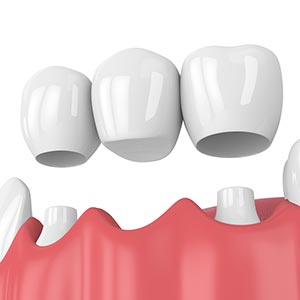 dental bridge supporting three crowns