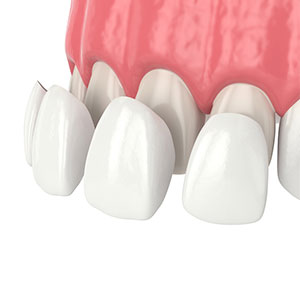 dental veneers on four upper teeth